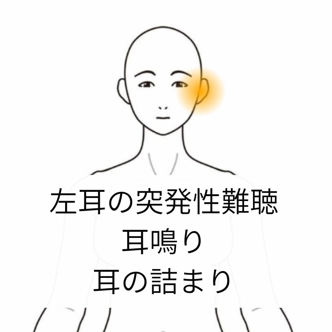 突発性難聴の症例（院長施術）